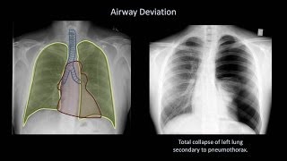 How to Interpret a Chest XRay Lesson 4  Airways Bones and Soft Tissues [upl. by Critta]