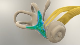 Menieres Disease  What Happens in the Inner Ear [upl. by Aluin]