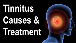 What is Tinnitus Causes amp Treatment Strategies [upl. by Pippas]